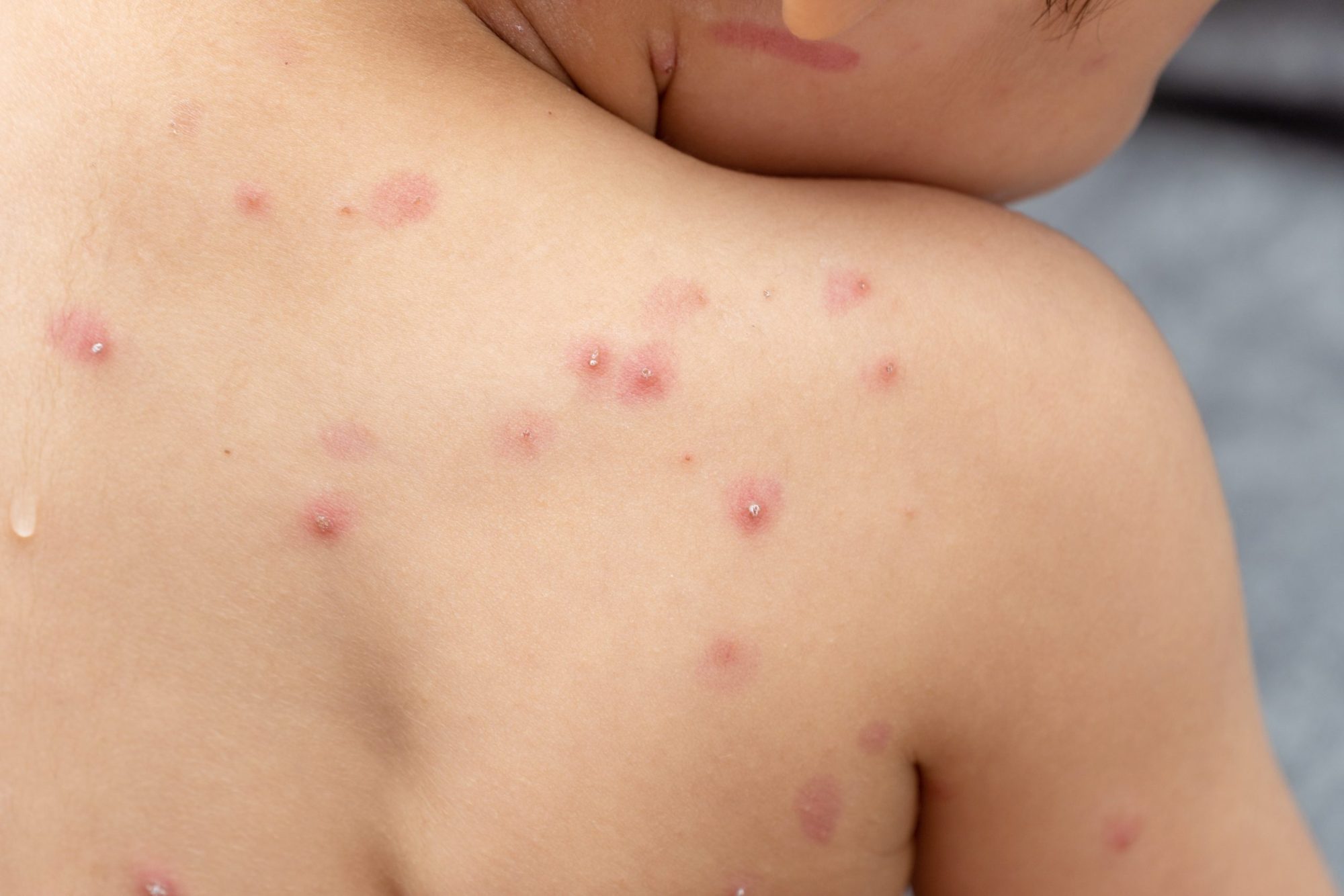 chicken pox