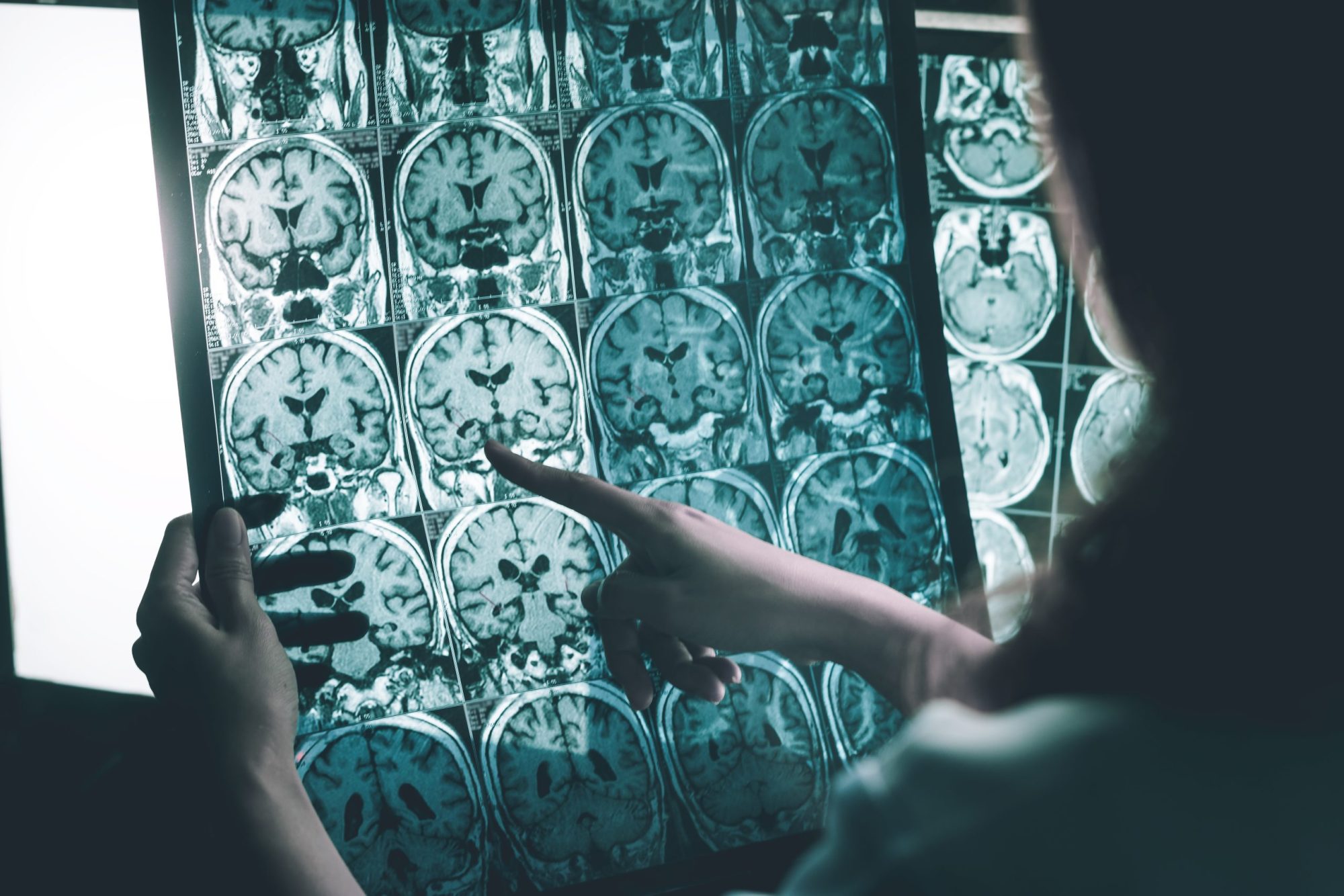 alzheimers