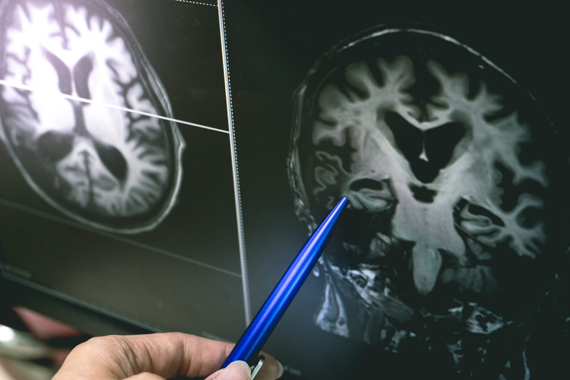Alzheimer’s Breakthrough: 5 Insights on Lecanemab’s UK Approval